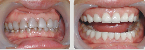 色素牙美白多少錢(qián)