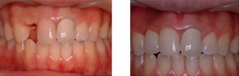 漳州門牙種植哪里好