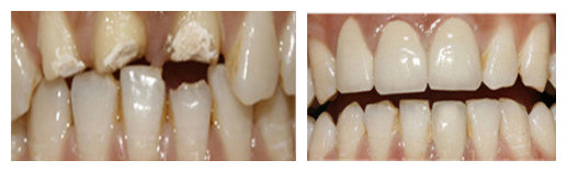 牙齒缺損修復(fù)方法有哪些