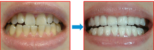 全瓷牙的類型有哪些