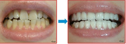 漳州全瓷牙好用嗎