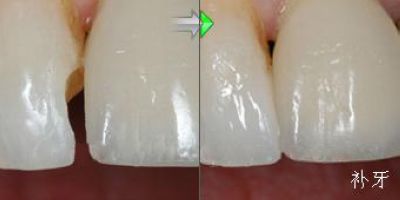 補(bǔ)牙后有哪些注意事項