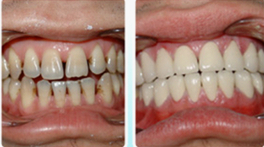 患有磨牙癥的人可以做烤瓷牙嗎