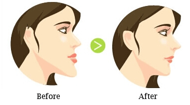 漳州地包天矯正會有后遺癥嗎