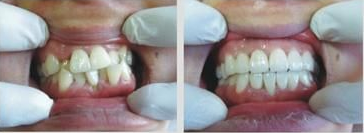 漳州美容冠矯正