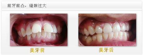 漳州牙齒前突能用美容冠矯正嗎