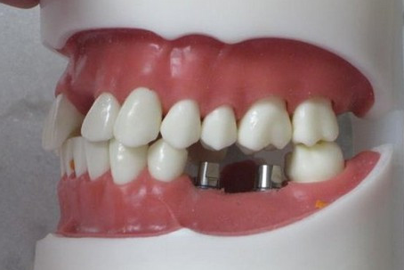 后牙缺失選用種植牙修復好嗎