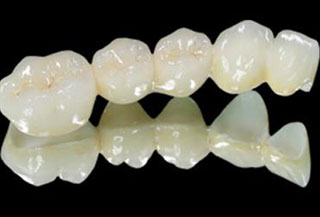 美容冠用久了會掉嗎