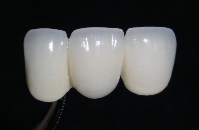 烤瓷牙的基本常識有哪些