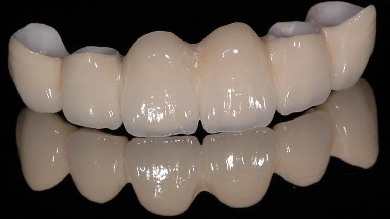 影響烤瓷牙品質(zhì)的因素有哪些呢