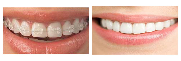 你對隱形正畸了解多少