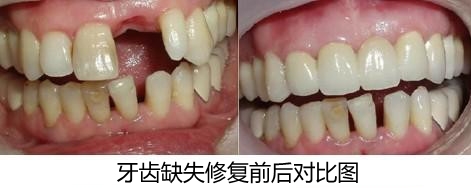 前牙缺失怎么辦