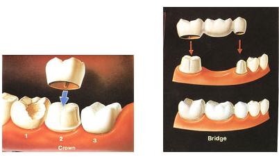 如何護(hù)理美容冠