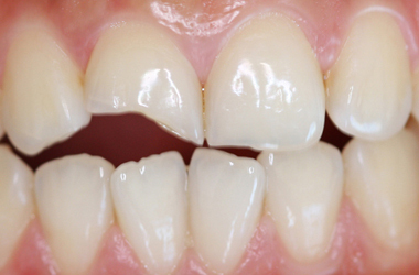 漳州牙齒缺損的常見癥狀有哪些