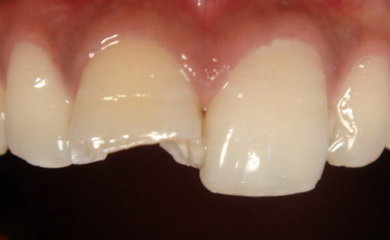 漳州牙齒缺損怎么辦