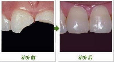 漳州牙齒缺損會帶來什么危害
