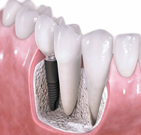 漳州老人牙齒缺失選擇鑲牙還是種植牙