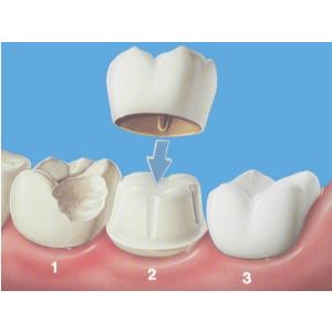 漳州鑲牙需要多少錢