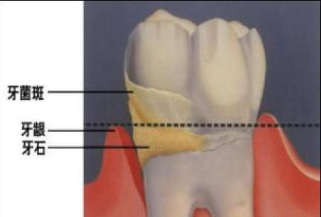 漳州如何預防牙菌斑