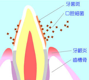 漳州牙菌斑有哪些危害