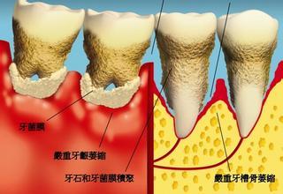 漳州牙齦萎縮的危害有哪些