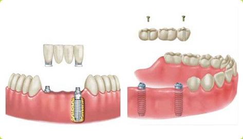 漳州多牙缺失可以做種植牙嗎