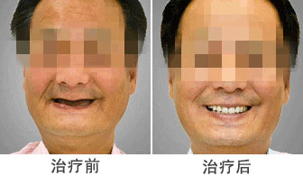 漳州牙齒全口缺失做種植牙有哪些程序