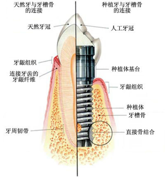 漳州牙齒全口缺失做種植牙好嗎