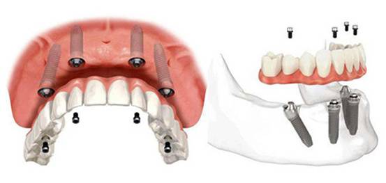 漳州全口缺失修復(fù)需要多少錢