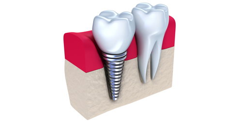 漳州種植牙植骨有哪些要求