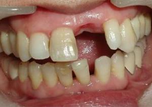 漳州門牙缺失會帶來哪些危害