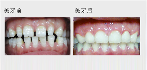 漳州牙齒稀疏有哪些方式可以修復(fù)